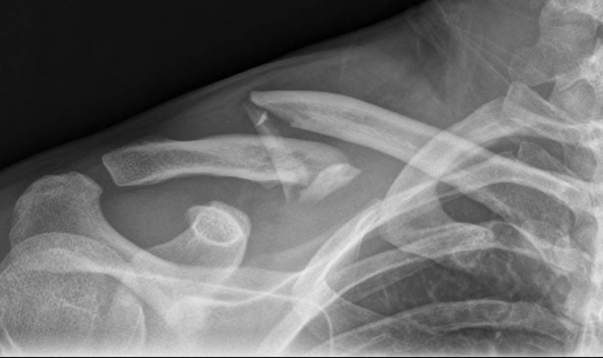 clavicle-fx1