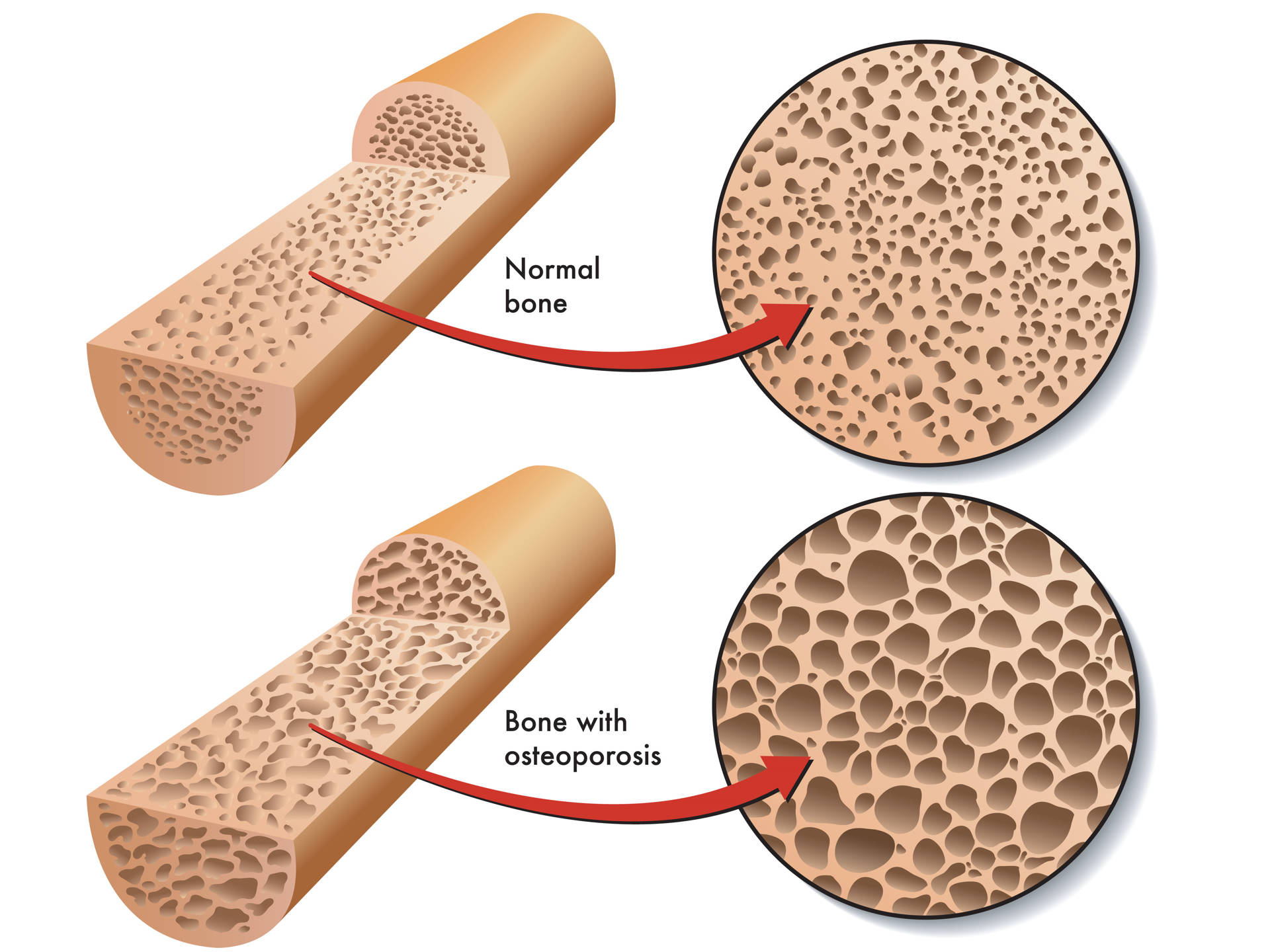 osteoporosis-bone